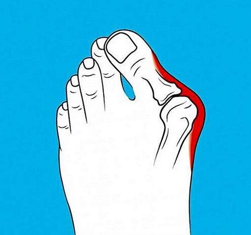 артроз сустава на пальцы ногі